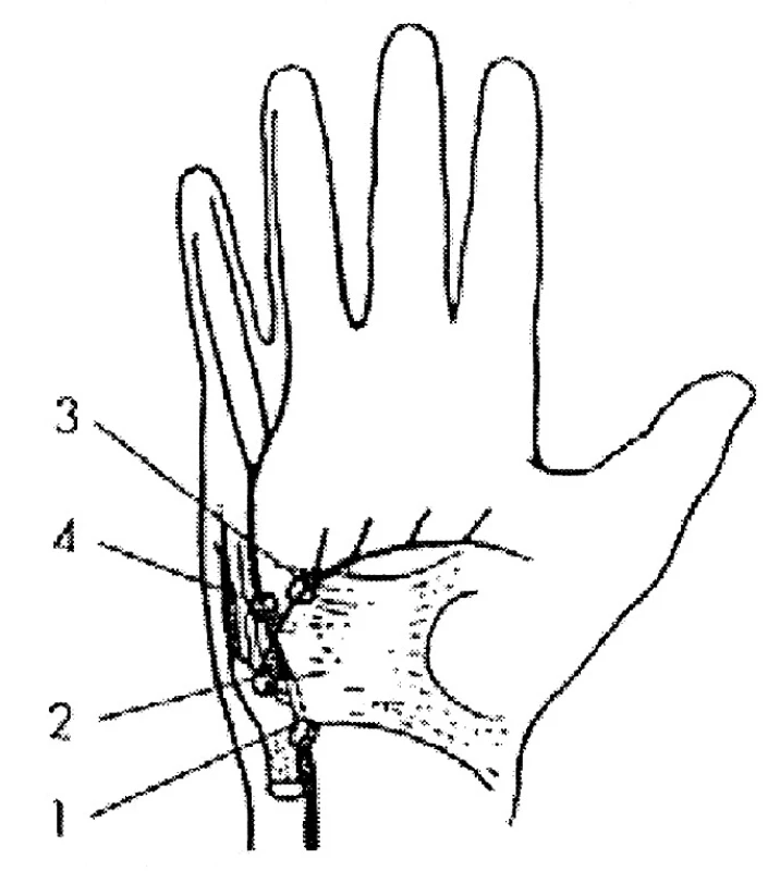 N. ulnaris – oblast zápěstí a ruky (lokalizací lézí)
1 – Guyonův kanál,
2 – r. profundus – léze motorických vláken pro hypothenar
a interosseální svaly (syndrom ligamentum pisohamatum),
3 – r. profundus distálně od odstupu vláken pro hypothenar,
4 – 