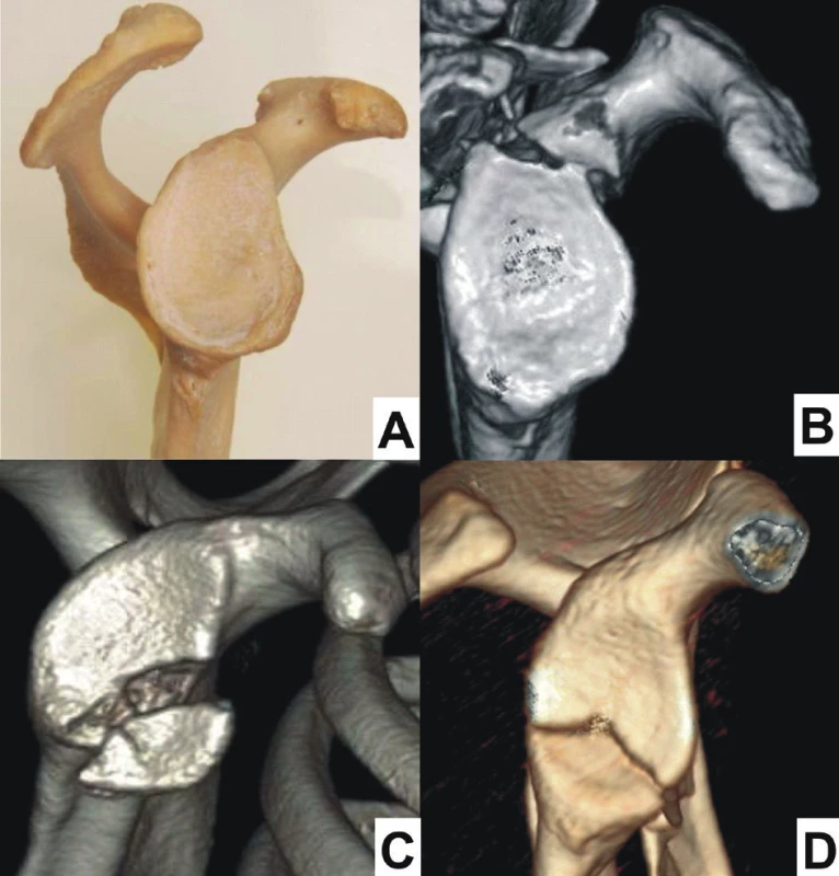 Zlomeniny glenoidu: A – normální glenoid, B – zlomenina horního glenoidu; C – zlomenina předního glenoidu; D – zlomenina dolního glenoidu.
Fig. 8: Fractures of glenoid fossa: A – normal glenoid fossa; B – fracture of superior glenoid; 
C – fracture of anterior glenoid; D – fracture of inferior glenoid