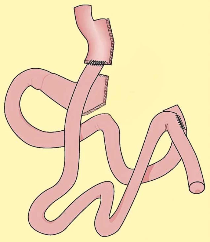Konverze sleeve gastrectomy na Roux-Y žaludeční bypass     Fig. 4: Conversion of sleeve gastrectomy to Roux-Y gastric bypass