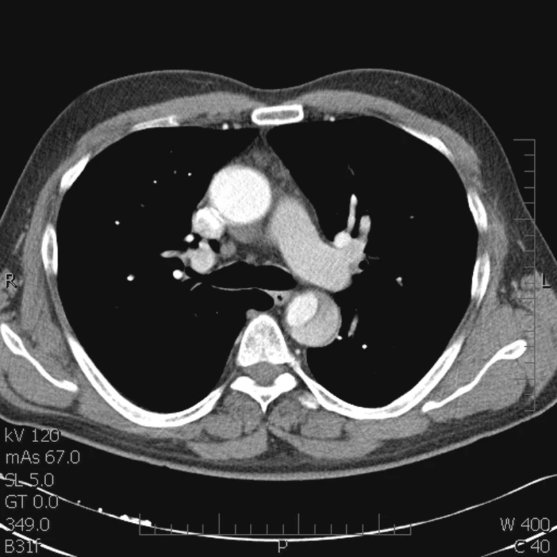 Falešné ústí začíná těsně pod levou a. subclavia
Fig. 1. A false orifice starting under the left subclavian artery 

