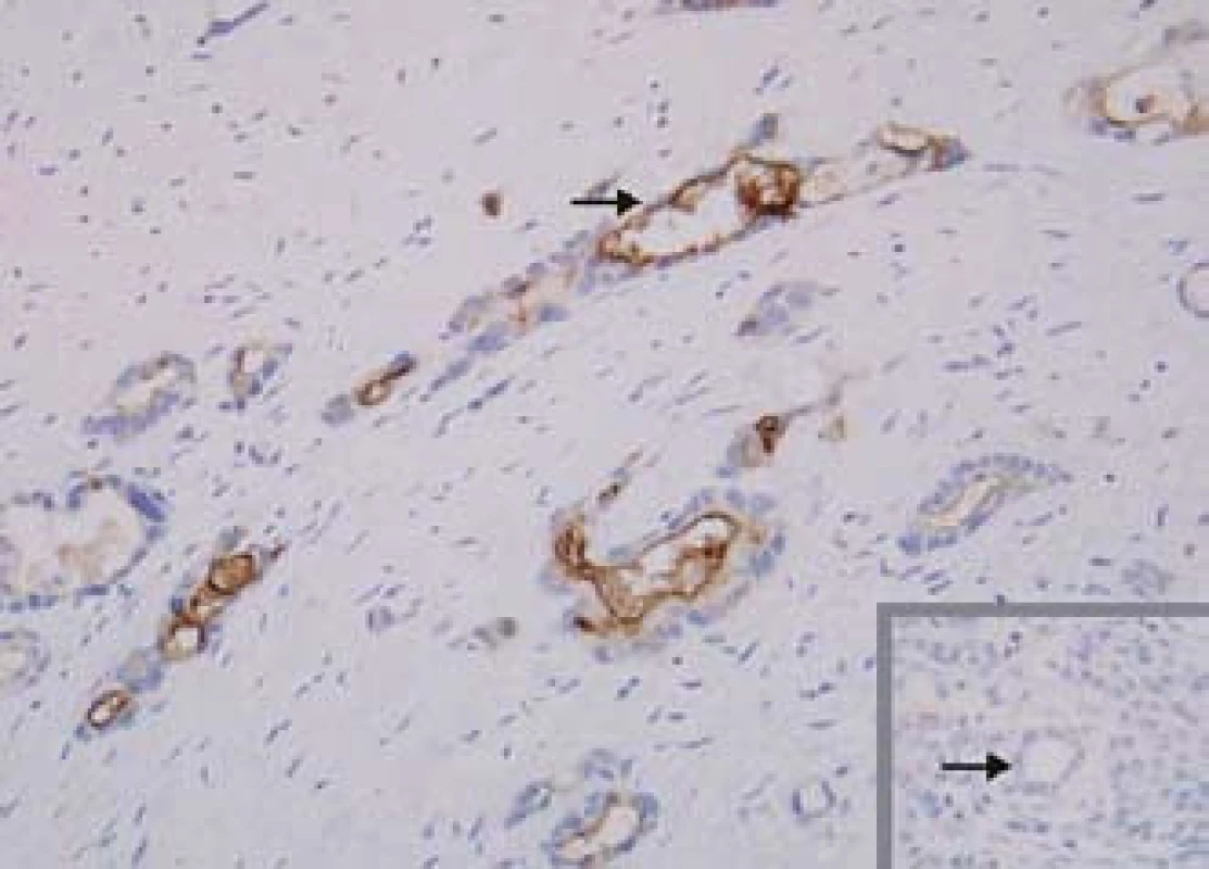 Exprese mezotelinu. Mezotelin je selektivně exprimován buňkami karcinomu pankreatu, exprese v normálním pankreatu není přítomna (vpravo dole).
Fig. 3. Mesothelin expression. Mesothelin is expressed selectively in pancreas cancer cells, expression is not found in normal pancreas (bottom right).