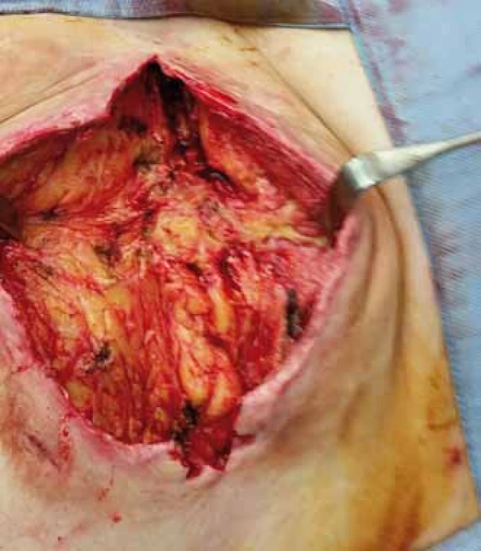 Obraz dekubitu po nekrektomii.
Fig. 3. Image of decubitus (pressure ulcer) after necrectomy.