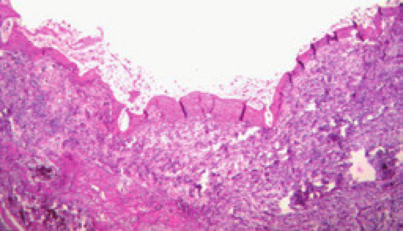 Primární trombus (tři dny po zavedení TIPS).
Fig. 2. Primary thrombus (three days after introduction of TIPS).