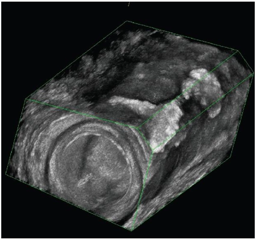3D endosonografický obraz rozvětvené píštěle
Fig. 2: 3D endosonography imaging of ramified fistula