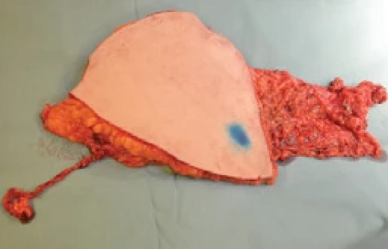 Right-sided hemiDIEP with lymph nodes and two pedicles transferred to left hemithorax as left breast and drainage for left axilla.
