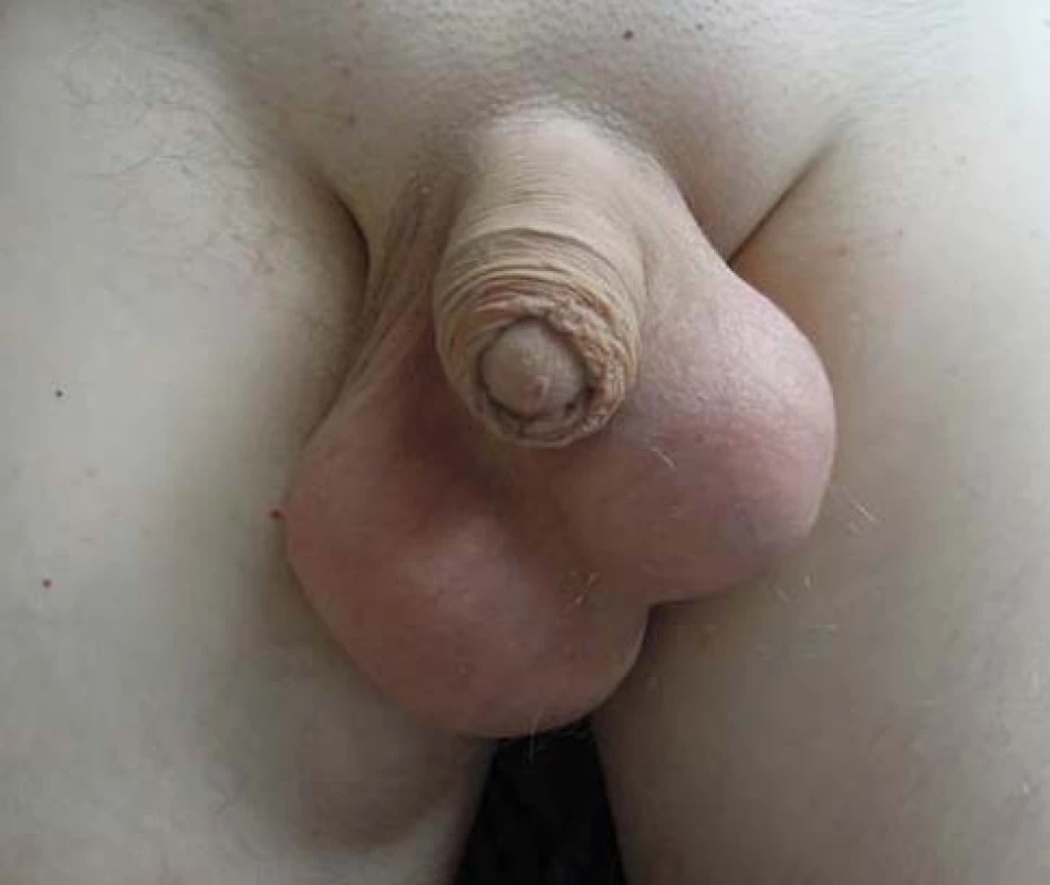 Synchronní bilaterální tumor varlete, foto před operací
Fig. 1. Synchronous bilateral testicular tumour, preoperative photo