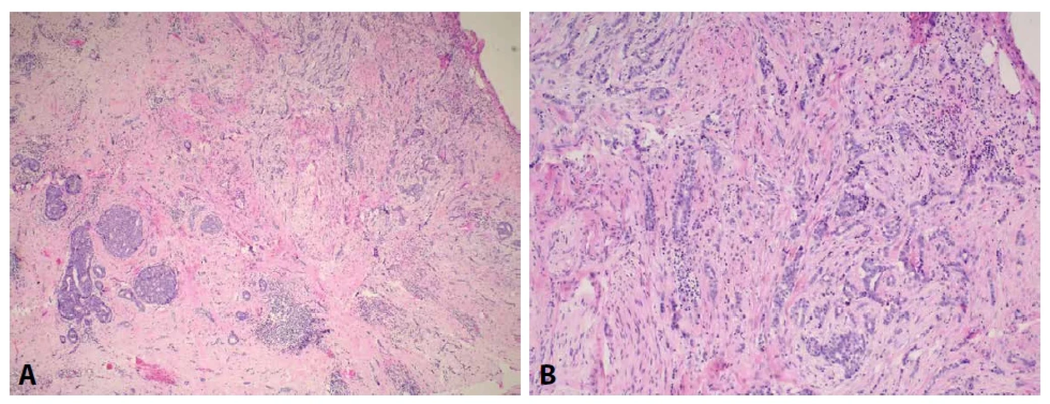 Případ 1 – nález v prsu, invazivní karcinom NST G2. (A hematoxylin a eozin, zvětšeno 40x, B hematoxylin a eozin, zvětšeno 100x).