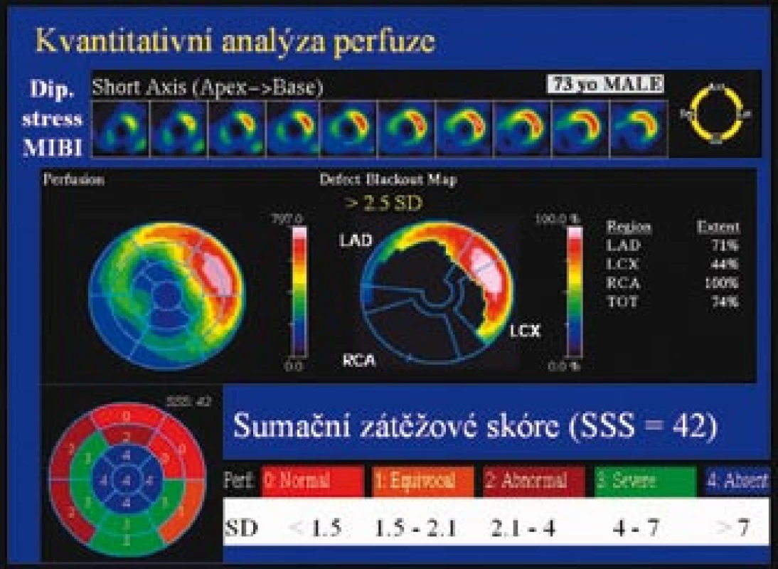Ukázka možností kvantifikace perfuzní abnormality u 73letého muže. Pomocí tzv. „defect blackout map“ je znázorněn rozsah defektu (74 % z levé komory), který zasahuje do všech povodí všech 3 koronárních tepen [36].
