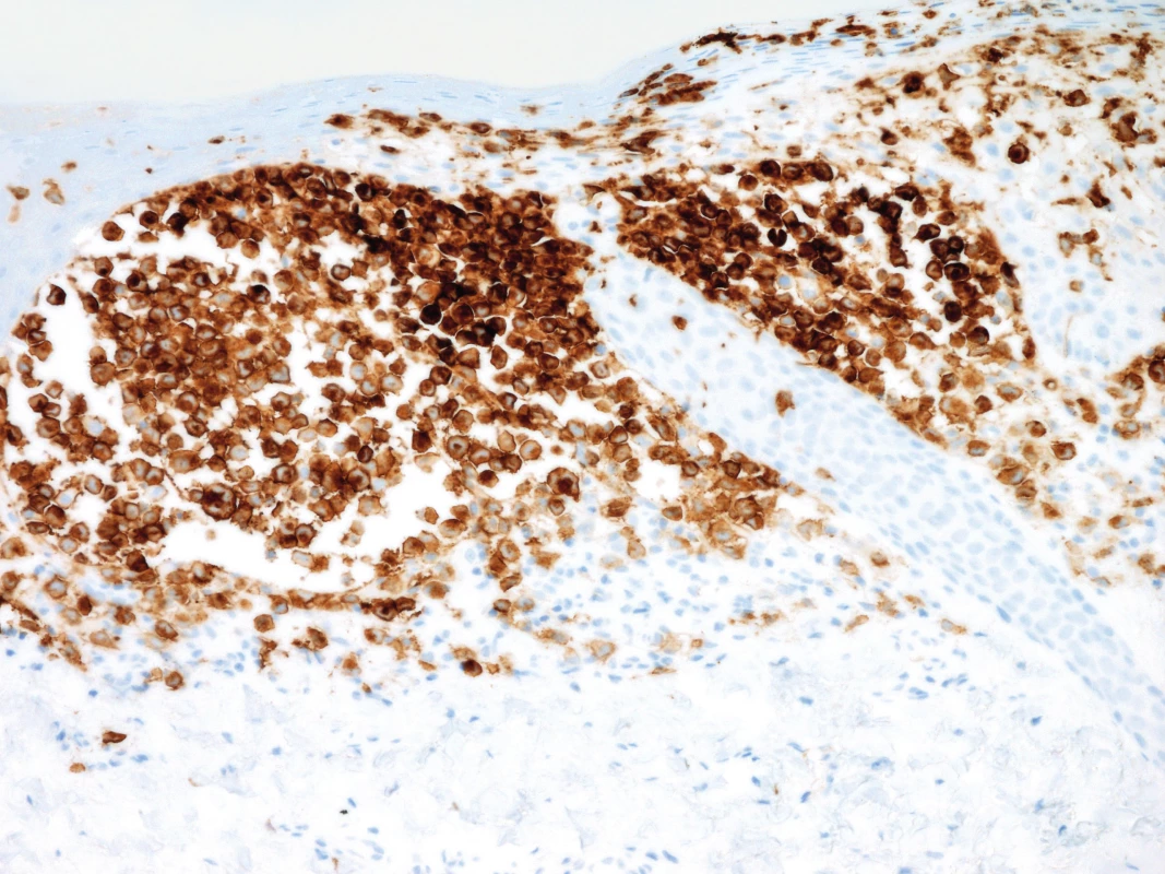 Pozitivní imunohistochemický průkaz CD1a antigenu v nádorových buňkách, 200x zvětšeno.
Fig. 6. Positive imunnohistochemical demonstration of CD1 antigen in tumorous cells, 200x enlargement.