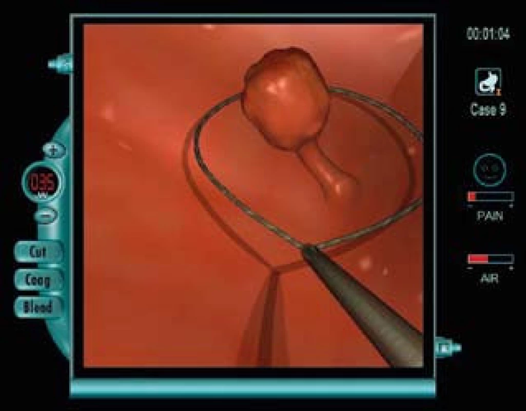 Modul pro koloskopii. Nalezený stopkatý polyp bude odstraněn endoskopickou polypektomií pomocí diatermické kličky (za použití smíšeného proudu).
Fig. 5. Module for colonoscopy. A pendiculated polyp will be removed by endoscopic polypectomy via diathermic snare (using a blended current).