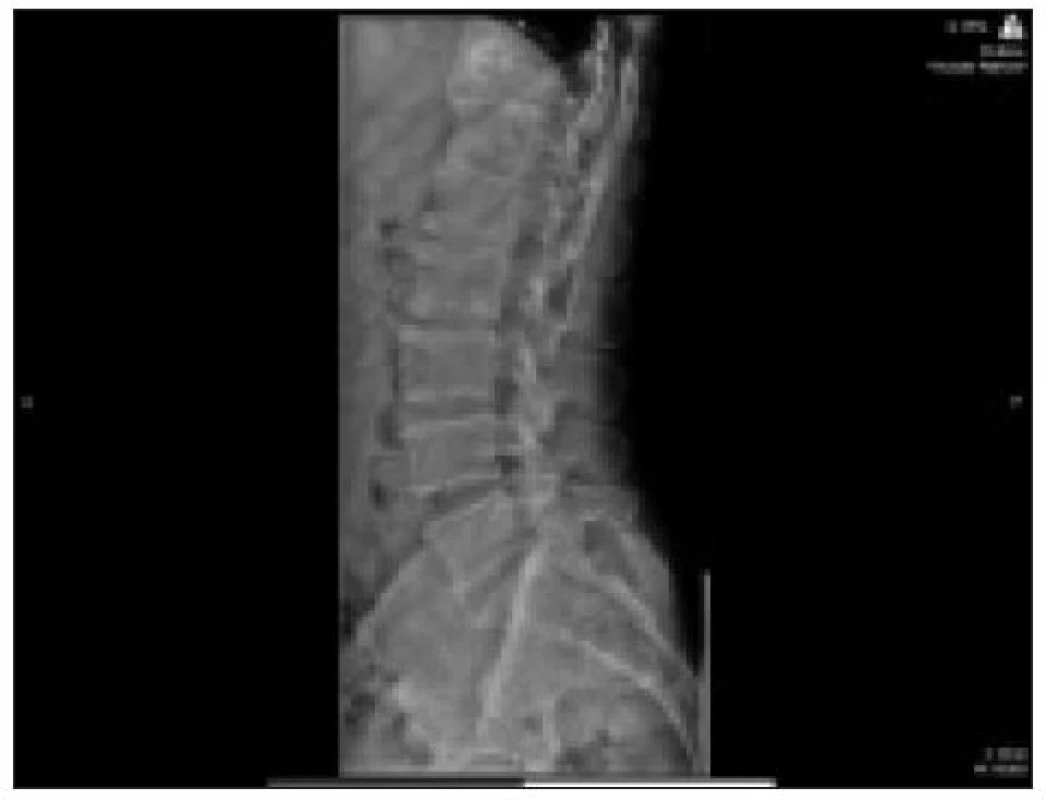 Předozadní a boční snímek páteře pacienta, který byl více než 2 roky v remisi mnohočetného myelomu. Ke svému lékaři přišel pro bolesti v páteři vystřelující do nohou, které se postupně zhoršovaly. Byl odeslán na neurologii, kde dostával klasickou analgetickou a myorelaxační léčbu bez dalšího laboratorního a zobrazovacího došetření. Lékaři k němu přistupovali jako ke každému jinému pacientovi s vertebrogenními potížemi a nerespektovali přítomnost rizikového faktoru, kterým je diagnóza mnohočetný myelom. Teprve až se mu na kalvě objevila hmatná rezistence, byl odeslán na specializované pracoviště, již omezeně chodící a s velmi atrofickými svaly dolních končetin. Akutní MR vyšetření ukázalo teprve příčinu tohoto zhoršení.