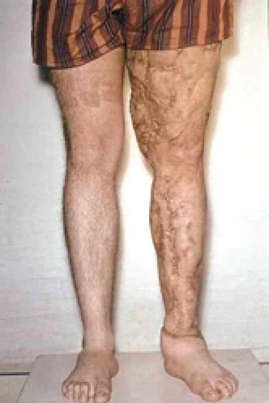 Long-term result of radical operation.