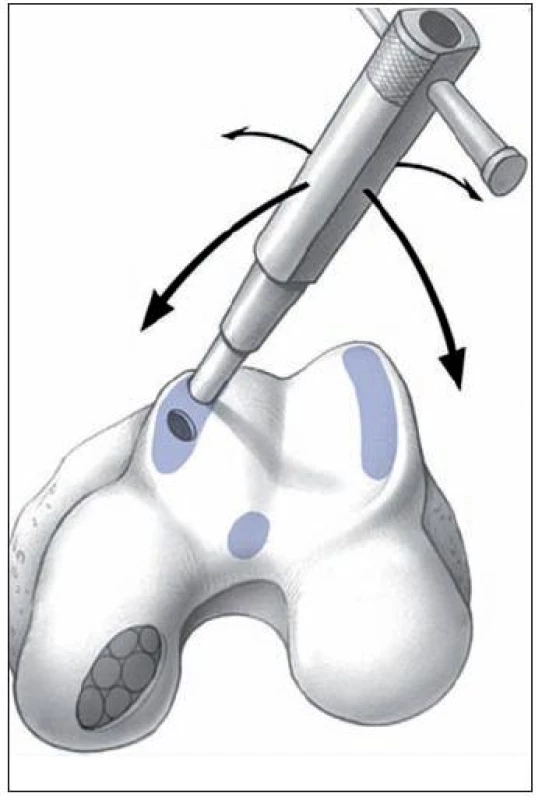 Autológna osteochondrálna mozaikoplastika – technika odberu a schématické znázornenie odberových miest. (Reprodukcia z Hangody L, Ráthonyi GK, Duska Z, et al. Autologous osteochondral mosaicoplasty. Surgical technique. J Bone Joint Surg Am 2004, 86, Suppl 1: 65–72)