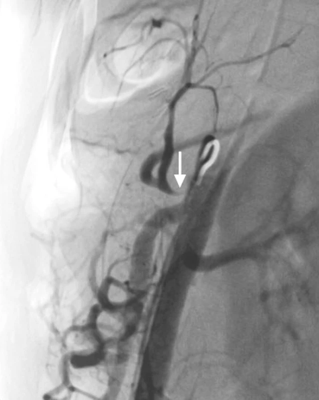 Angiografické vyšetření s průkazem krátké kritické stenózy těsně za odstupem truncus coeliacus. Stenóza průkazná při břišní aortografii (Obr. 2) i selektivní coeliakografii (Obr. 3)
Pic. 2 and 3. Angiography shows short critical stenosis at the origin of celiac trunk. The stenosis is evident in abdominal aortography (Picture 2) and selective celiacography (Picture 3)