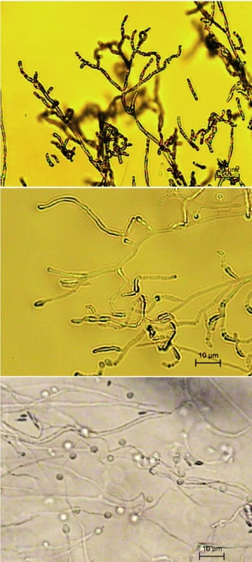 A. kalrae, a), b) retiazky stromčekovite vetvených artrokonídií, c) guľovité konídiá laterálne pozdĺž hýf (mikrokultúry, Sabouraudov agar, 7 dní, 25 °C)
Fig. 3a, 3b Arthrographis kalrae, branching chains of arthroconidia Fig. 3c Arthrographis kalrae, spherical conidia located laterally along the hyphae (microculture, Sabouraud agar, 7 days, 25°C)