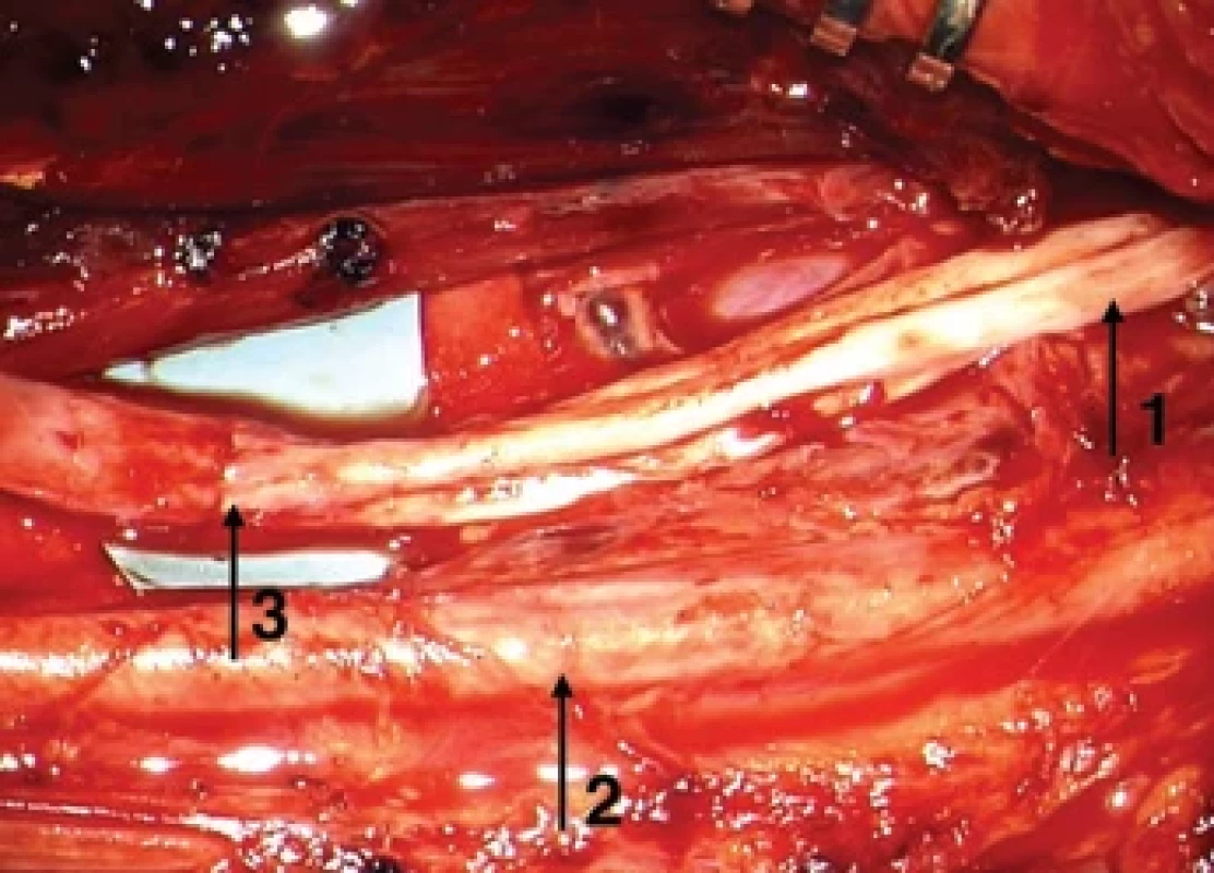 The sural nerve grafts anastomosed to MCN proximally (arrow 1) and distally (arrow 3), the median nerve and surrounding structures (arrow 2).