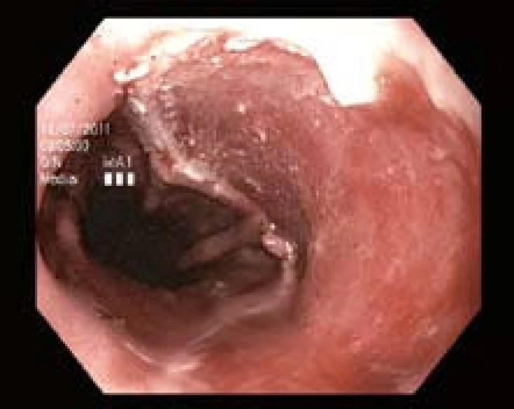 Resekční plocha po druhé etapě EMR.
Fig. 6. Resection zone after the second session of EMR
