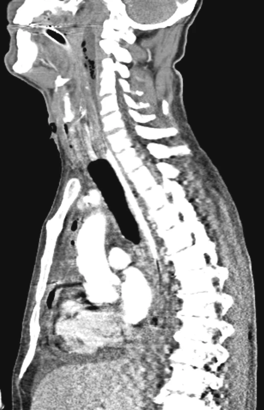 Sagitální rekonstrukce ukazující rozsah prevertebrálního abscesu v kraniokaudálním směru
Fig. 4. Saggital reconstruction showing the cranio-caudal extent of the prevertebral abscess