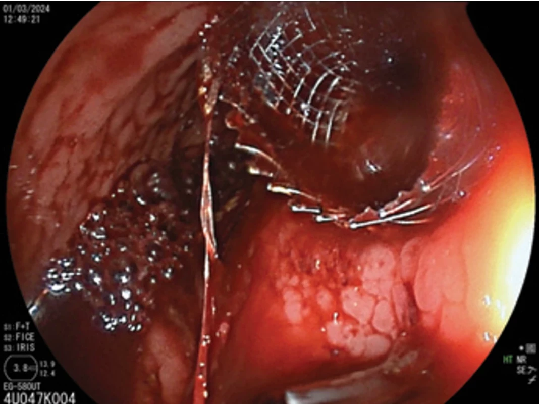  Endoskopický obraz bezprostredne po uvoľnení LAMS v lumene žalúdka. Fig. 4. Endoscopic view immediately after LAMS deployment.