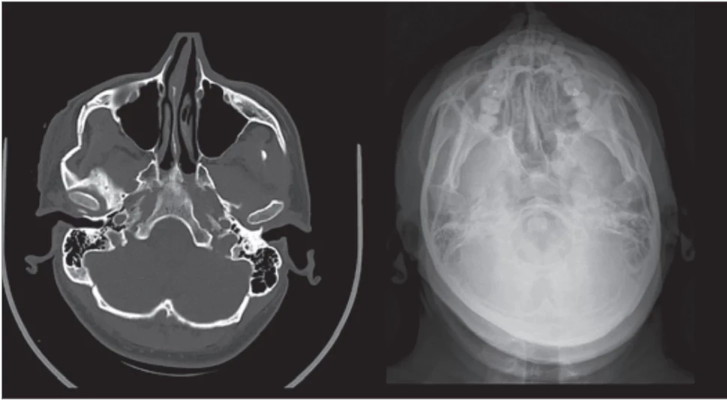 Left – zygoma arch fracture on the preoperative CT, right – postoperative axial radiograph.