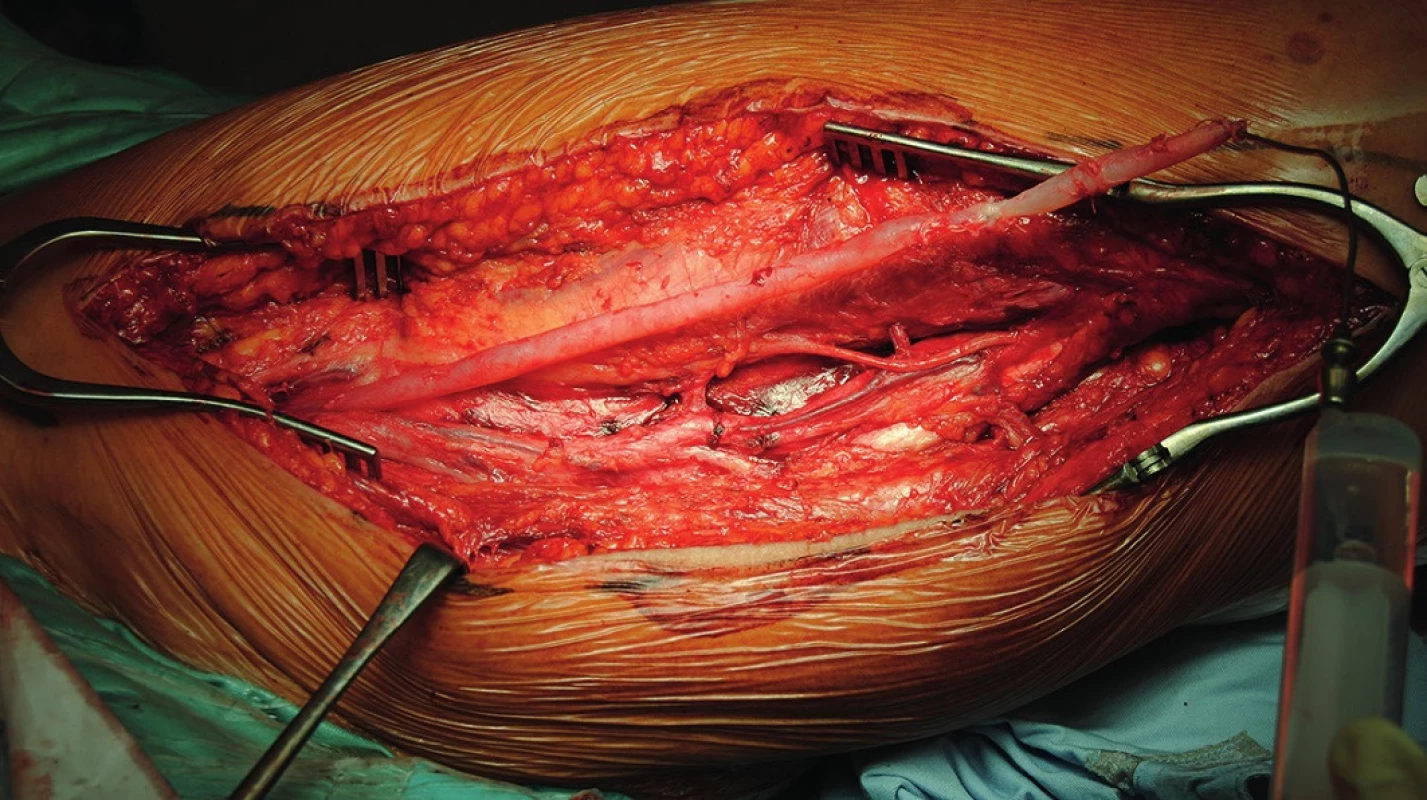 Vypreparovaná vena femoralis superficialis s ponechanou junkcí v třísle (soutok s vena profunda femoris)
Fig. 1: Dissected the superficial femoral vein with left junction in the groin (with the vena profunda femoris)
