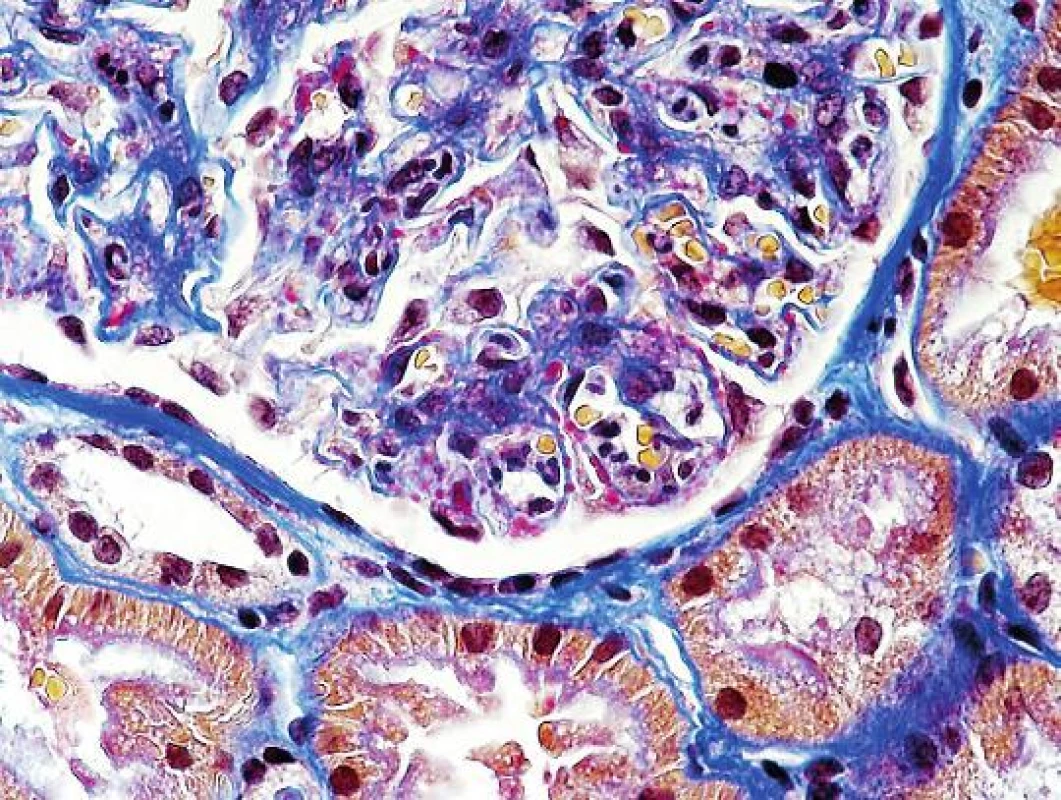 Detail části glomerulu s depozity na periferii kapilárních kliček u klasické postinfekční GN (depozita jsou karmínově červená, šipky, objektiv 60x, AFOG).