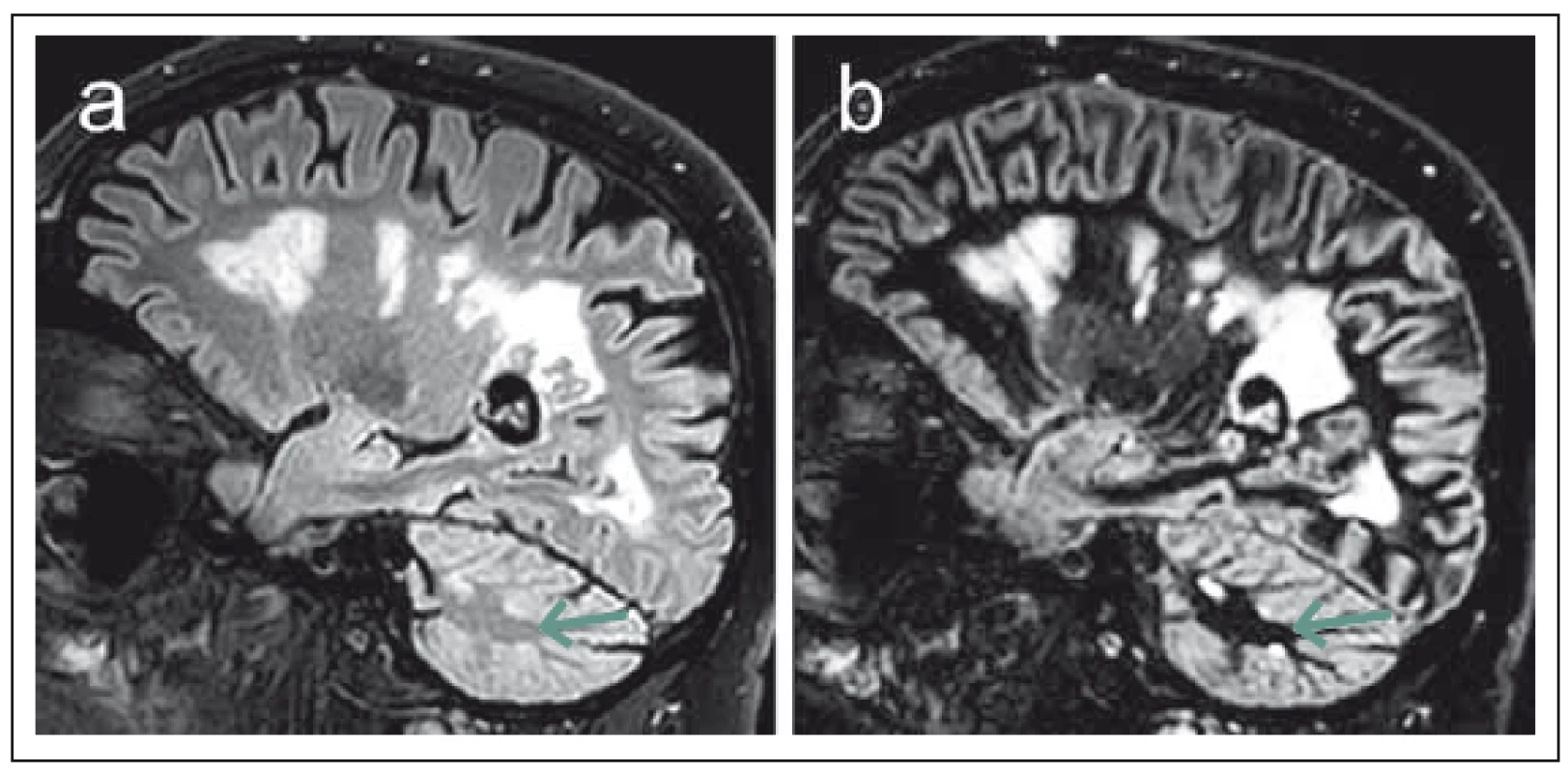 Srovnání sekvencí 3D FLAIR (fluid attenuated inversion recovery) (a) a DIR (double inversion recovery) (b) u pacienta s pokročilým postižením v rámci roztroušené sklerózy.
Fig. 2. Comparison of 3D FLAIR (fluid attenuated inversion recovery) (a) and DIR (double inversion recovery) (b). Sequences in a patient with advanced multiple sclerosis disability.