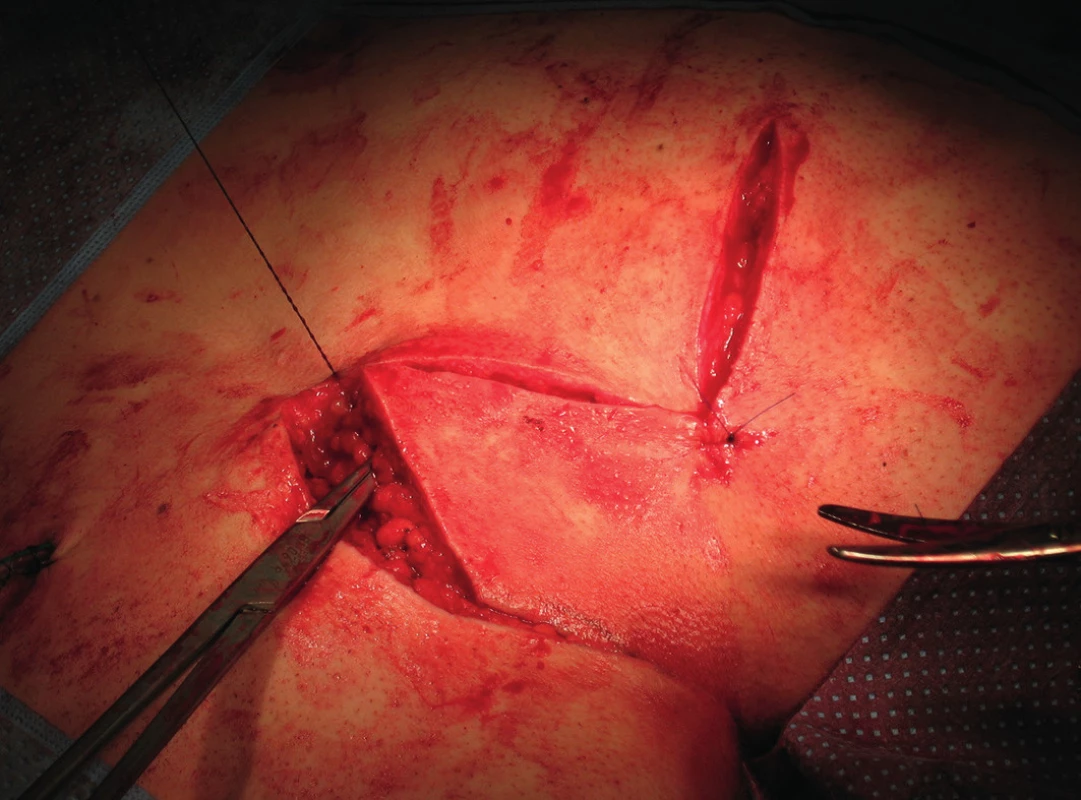 Rotace a sutura laloku
Fig. 4: Flap rotation and suture