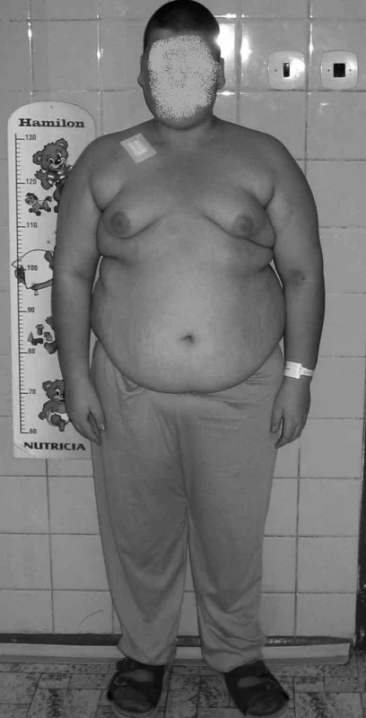 Typický klinický obrazmetabolického syndromu u dětí.
Fig. 2. Typical clinical picture of metabolic syndrome in children.