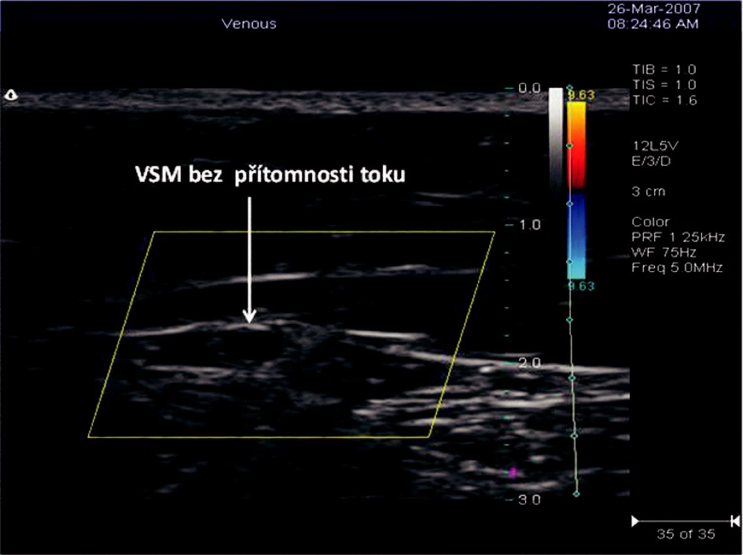 Příčný řez VSM v sono obraze po RFITT s odstupem 63 dnů od operace
Obr. 4. Ultrasound view of a transverze section of the VSM, 63 days after the RFITT procedure