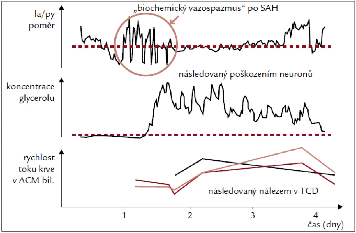 Lokální metabolické indikátory jsou časnou známkou incipientního vazospazmu a buněčného poškození u pacientů se subarachnoidálním krvácením (SAH). Upraveno podle [38].