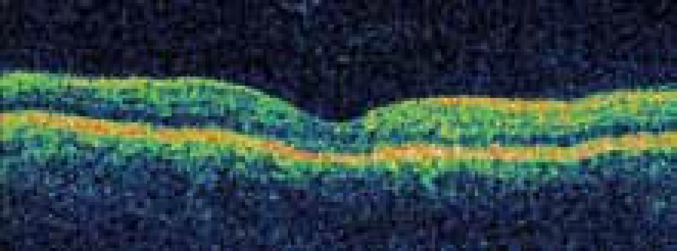Vymizení cystoidního makulárního edému levého oka po intravitreální aplikaci triamcinolonu a doplnění mřížkové laserové fotokoagulace.