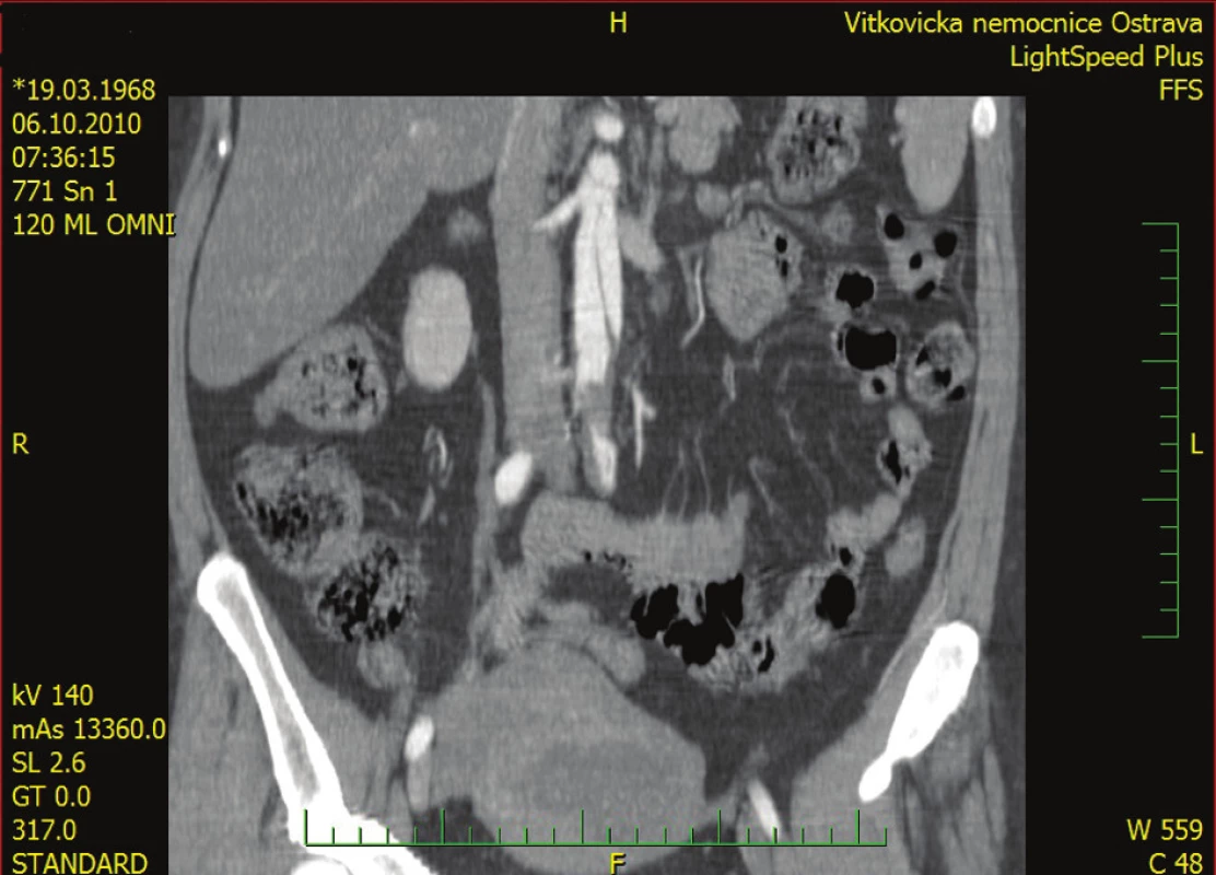 Obraz abdominální aorty v AP projekci Disekce zasahuje do úrovně renálních tepen.
Fig. 4: Picture of the abdominal aorta in anteroposterior projection Dissection reaches the renal arteries level.