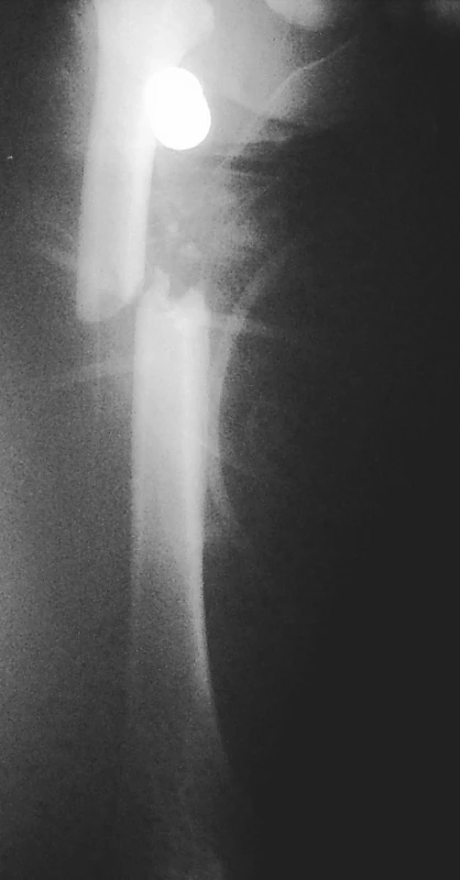 Úrazové RTG zlomeniny diafýzy stehenní kosti – foceno ve vakuové dlaze
Pic. 1. X-ray of diaphyseal femur fracture – x-rayed in a vacuum cast