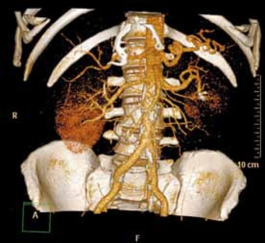 CT angiografie měsíc po embolizaci
Fig. 4. CT angiogram one month after embolisation