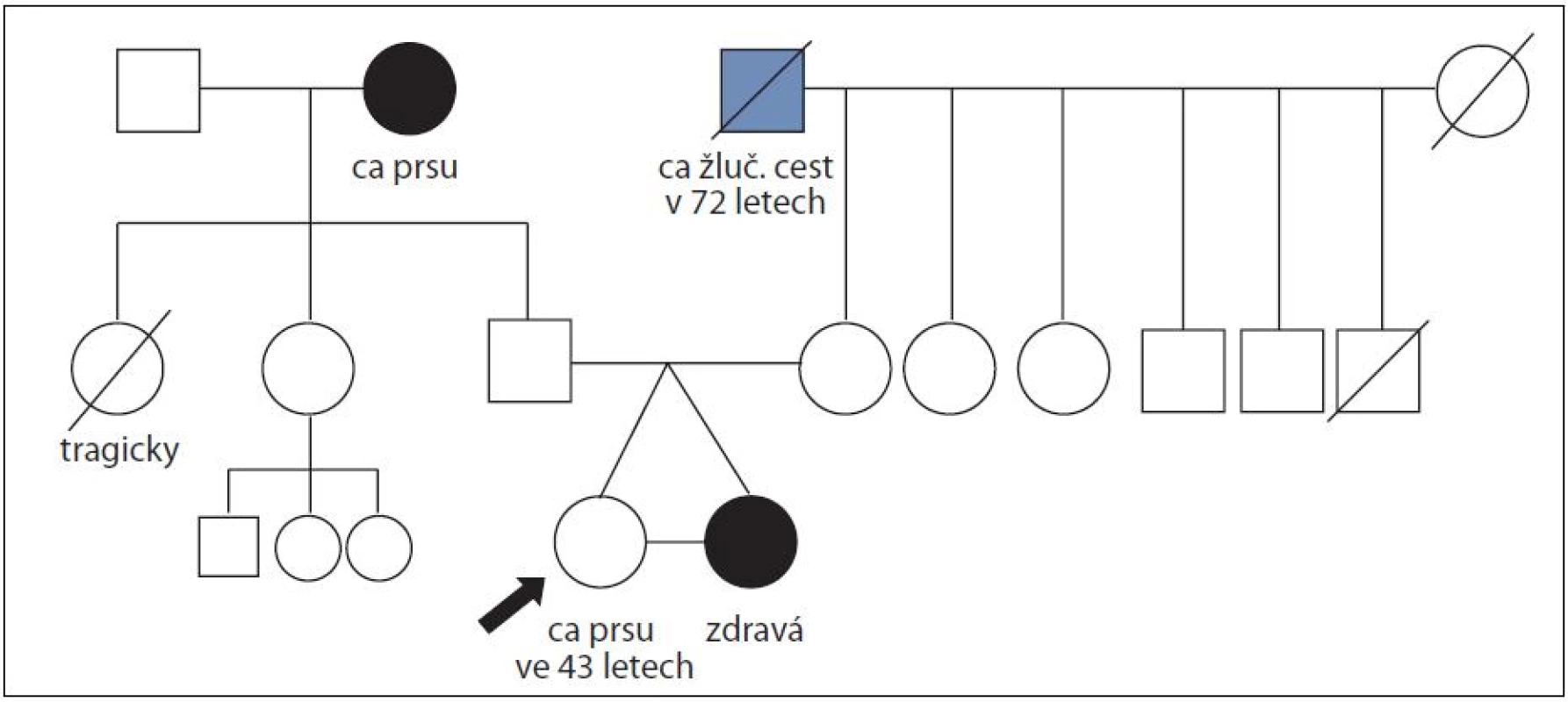 Rodina ženy s duktálním karcinomem prsu ve 43 letech a její monozygotní sestry, která nádorem prsu neonemocněla do věku 51 let; časový interval sledování 8 let; mutace v <i>BRCAL</i> genech nenalezena.