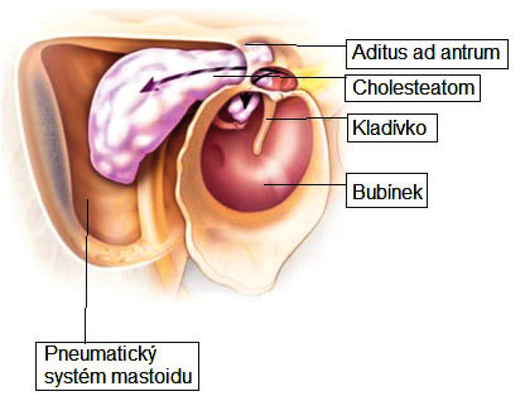 Cholesteatom středního ucha.
Fig. 7. Cholesteatoma of the middle ear.