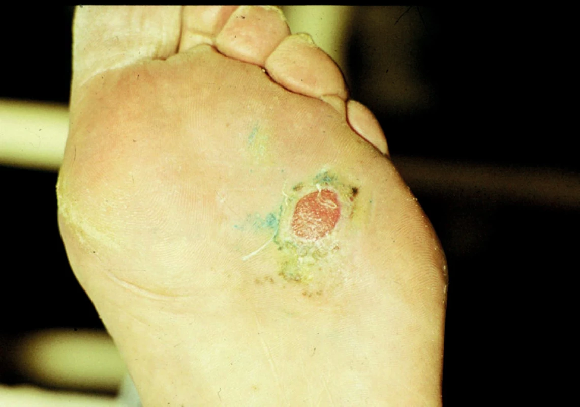 Ulcus neuropathicum diabeticorum.