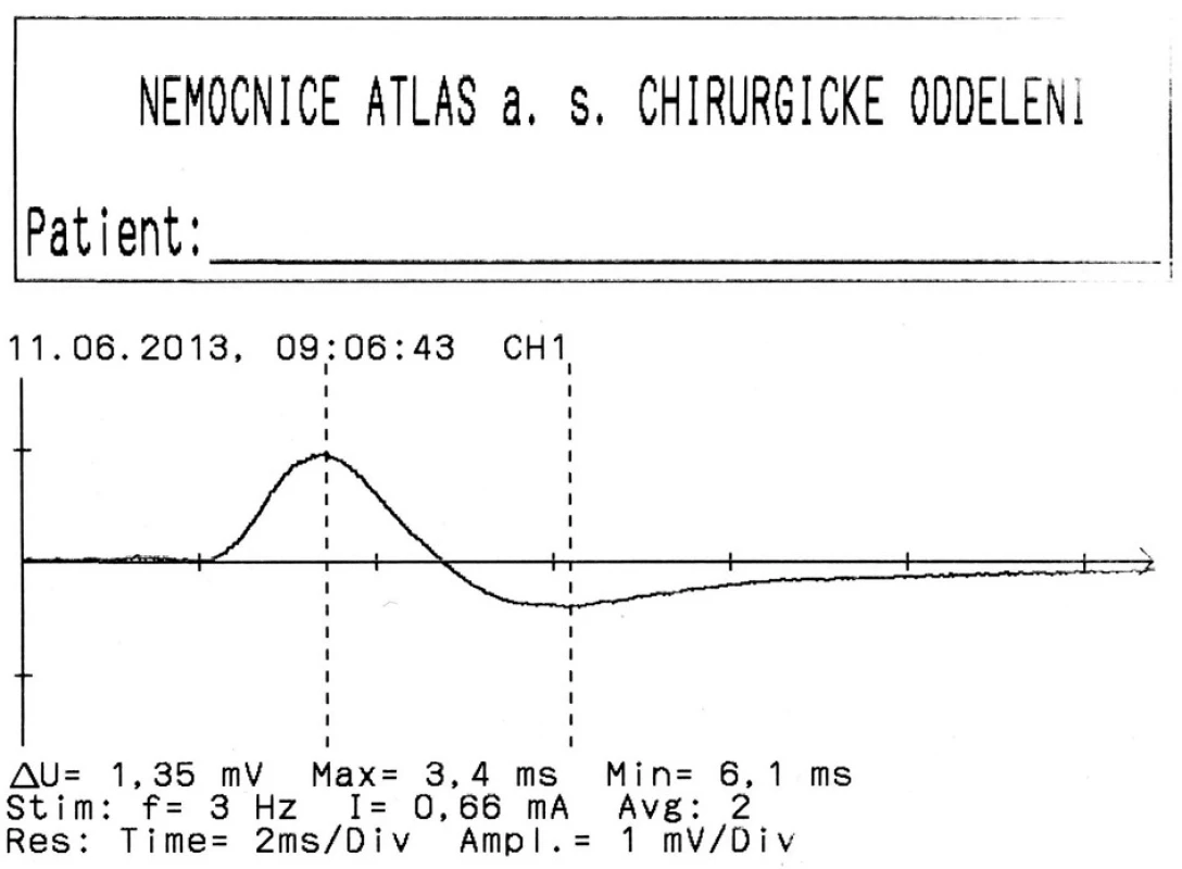 Záznam z neurostimulace
Fig. 3: Neuromonitoring record