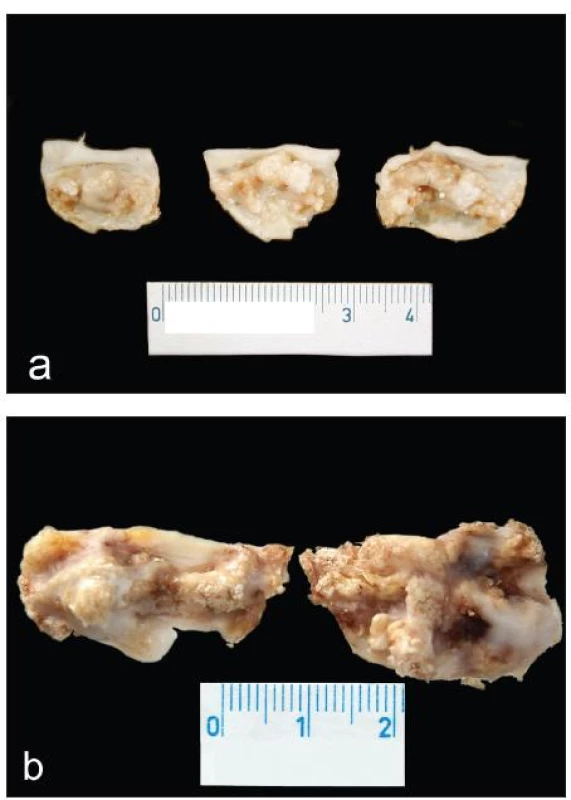 Surgical specimens of CAS: a) senile – “degenerative” type; b) bicuspid aortic valve
