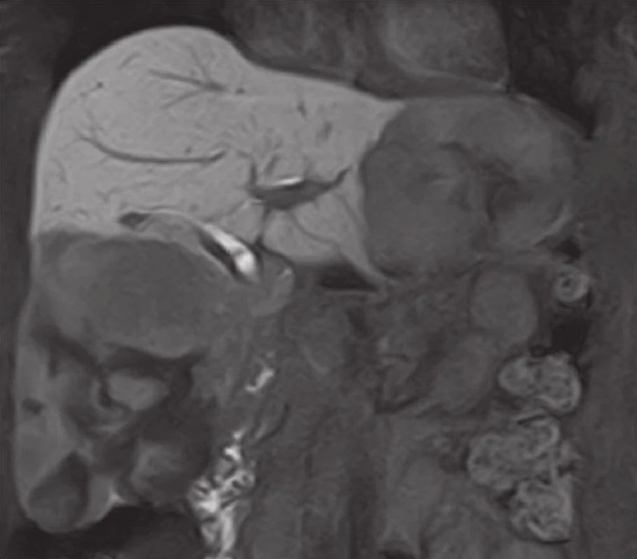 Magnetická rezonance jater – gigantické hemangiomy jater (14,9 a 9,2 cm) řešené enukleací
Fig. 2: Magnetic resonance imaging of the liver – giant liver hemangiomas (14.9 and 9.2 cm) managed using enucleation