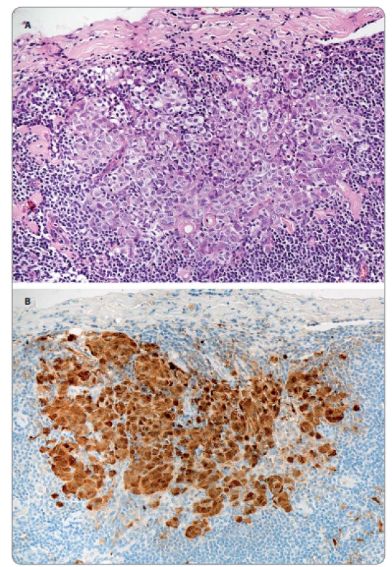 A. Mikrometastáza melanomu v sentinelové uzlině – nádorové buňky tvoří shluk o průměru cca 0,5 mm těsně pod pouzdrem (hematoxylin-eosin; 200×). B. Tatáž mikrometastáza – imunohistochemické ozřejmení nádorových buněk s protilátkou proti S100 proteinu (IHC S100 protein: DAB-hematoxylin; 200×).