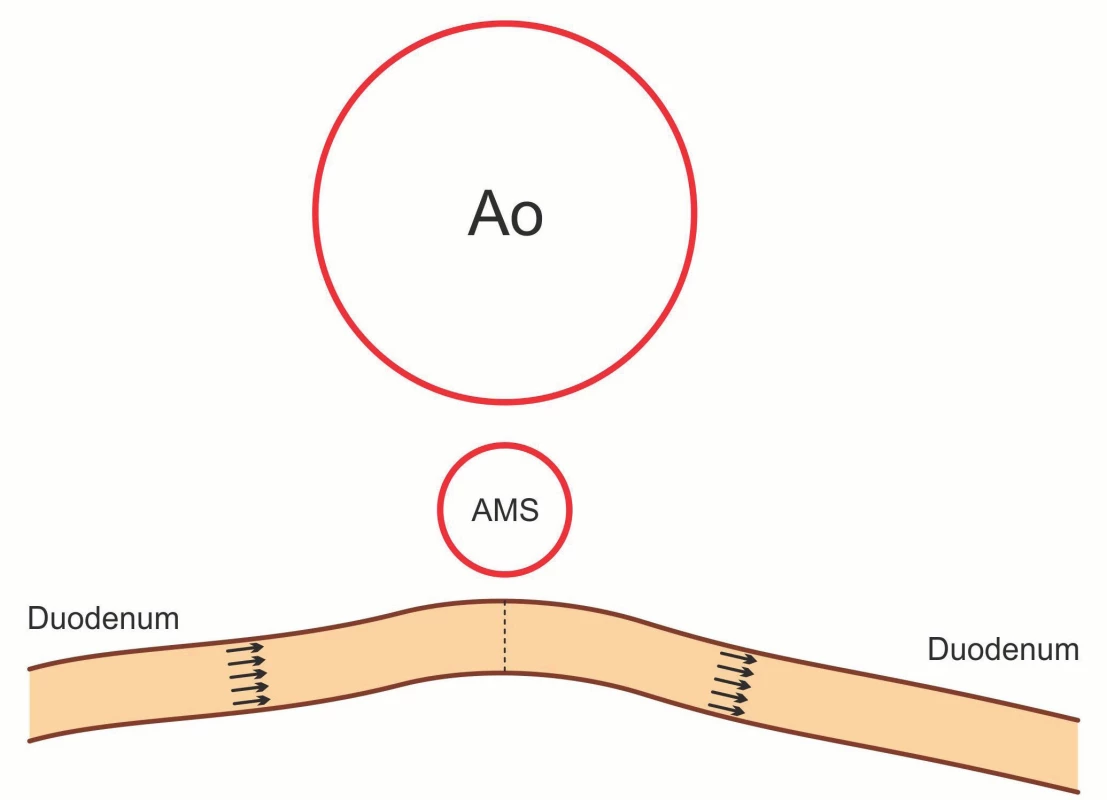 Schematické znázornění – duodeno-duodeno anastomóza end-to-end.
Fig. 7. Morphology of duodeno-duodeno anastomosis end-to-end.