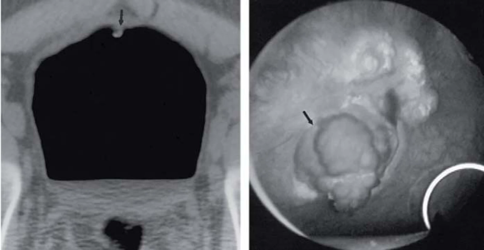 Obraz virtuální cystoskopie.
Song JH, Francis IR, Platt JF et al. Bladder Tumor Detection at Virtual Cystoscopy. Radiology 2001; 218(1): 95–100.