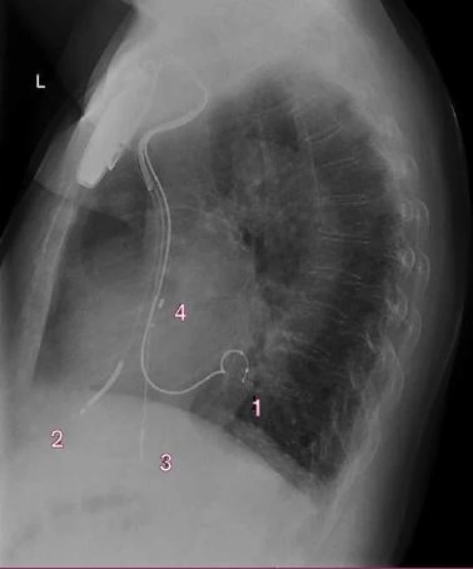 Kontrola za 14 dnů od implantace – boční snímek.