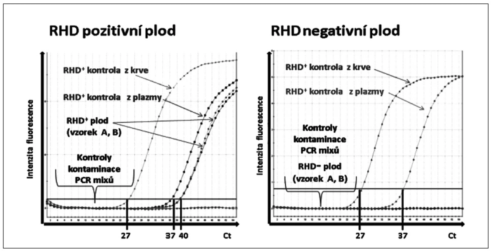 Ukázka rozlišení <i>RHD</i> pozitivního a <i>RHD</i> negativního plodu pomocí real-time polymerázové řetězové reakce (PCR).
Amplifikační křivky znázorňují fluorescenční intenzitu exonu 7 genu <i>RHD</i> v závislosti na počtu PCR cyklů (Ct). <i>RHD</i>+ kontrola z krve: <i>RHD</i>+ DNA izolovaná z leukocytů periferní krve. <i>RHD</i>+ kontrola z plazmy: <i>RHD</i>+ DNA izolovaná z krevní plazmy těhotné <i>RHD</i>- ženy. <i>RHD</i>+ plod: <i>RHD</i>+ vzorky („A“a „B“) DNA izolované z krevní plazmy těhotné <i>RHD</i>- ženy. <i>RHD</i>- plod: <i>RHD</i>- vzorek DNA izolované z krevní plazmy těhotné <i>RHD</i> negativní ženy. Kontroly kontaminace PCR <i>RHD</i>: PCR mix pro DNA izolovanou z leukocytů s PCR vodou a PCR mix pro DNA izolovanou z plazmy s PCR vodou.