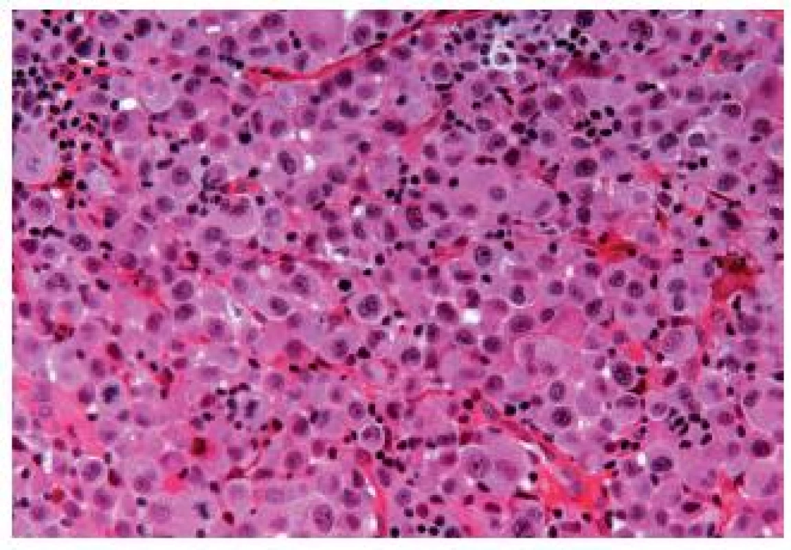 Undifferentiated giant cell UC, tumor cells have eosinophilic abundant cytoplasm.