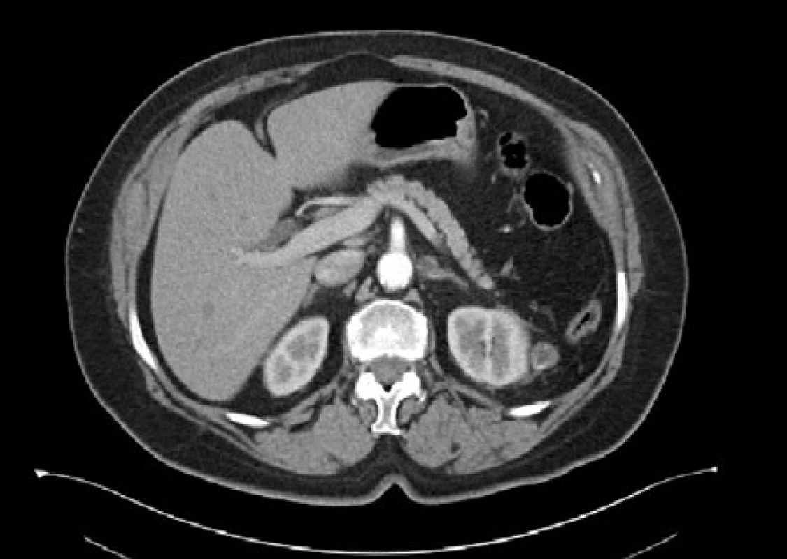 <i>CT zobrazení – Bosniak IIF</i>
Fig. 5. <i>CT imaging – Bosniak IIF</i>
