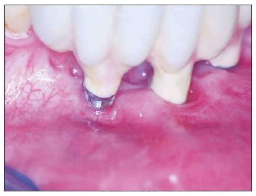 A 3-year recall – detail of implant 41 – 1 mm dehiscence