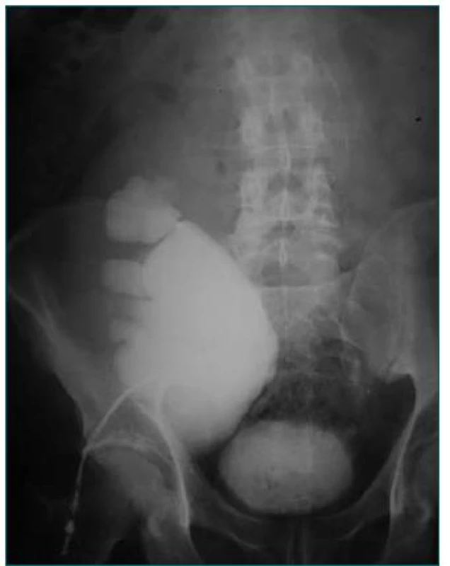 Hydronefróza transplantovanej obličky podmienená zalomením močovodu v mieste pyelo-ureterálnej junkcie.